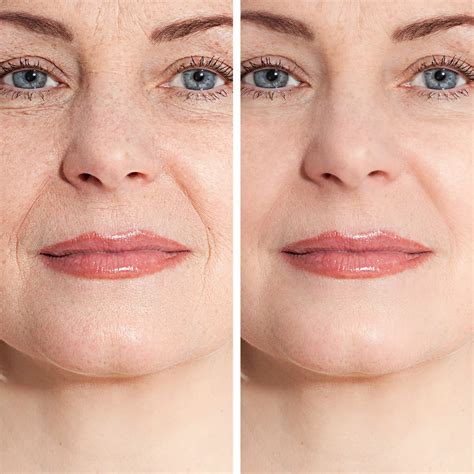 Restylane Refyne Injectable Fillers in Santa Rosa and Healdsburg