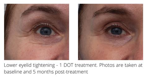 DOT therapy - Anti-ageing skin rejuvenation, acne scarring ...