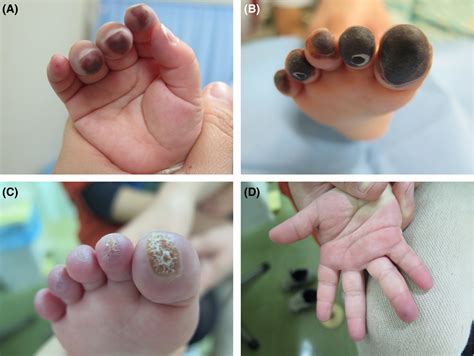 Raynaud’s Phenomenon - Dr Qaisar Ahmed MD, DHMS - Best Homeopathic