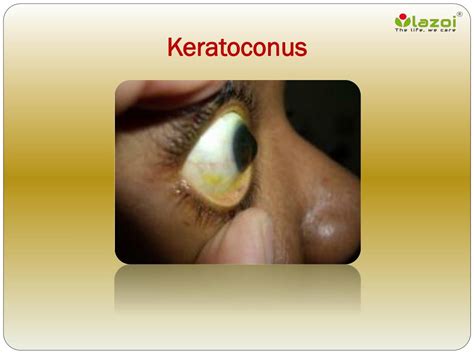 PPT - Keratoconus: Causes, Symptoms, Daignosis, Prevention and