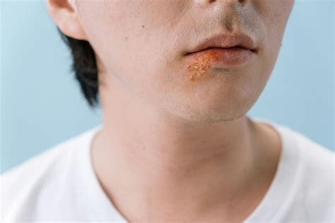 HFMD Symptoms & Contagious Period: How Long This…