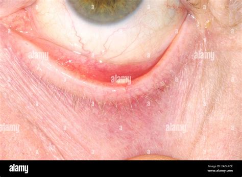 eye cyst chalazion chalazion traitement nzne