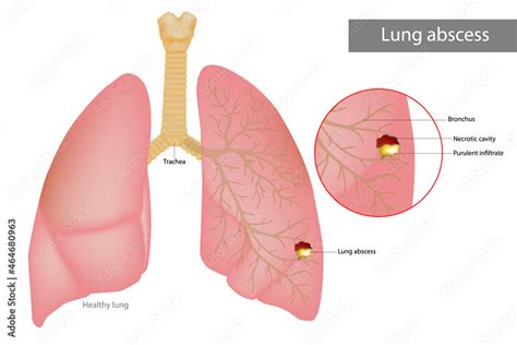 Lung abscess is a type of liquefactive necrosis of the lung tissue ...