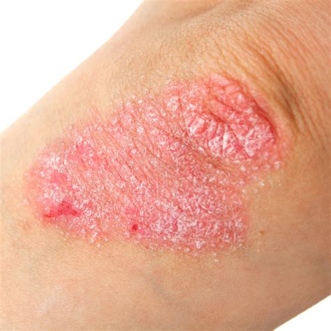 Eczema Flare-Up: Here’s How To Keep Symptoms Under Control? - Terris ...