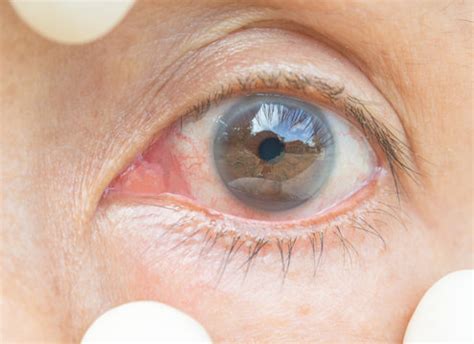 conjunctivitis bilder bladdra bland  stockfoton vektorer och