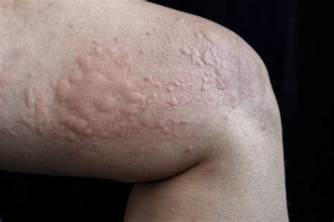 Hives (urticaria): Causes, Pictures, Treatments, And, 53% OFF
