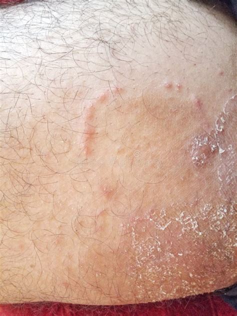 Tinea Cruris Stock Photos - Free & Royalty-Free Stock Photos from ...