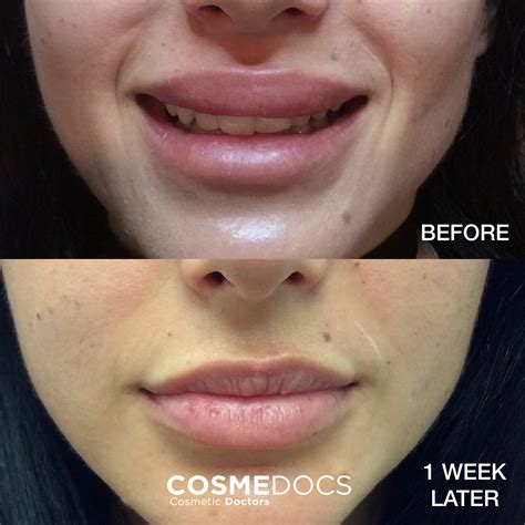 White Spots On Lips After Fillers - Infoupdate.org