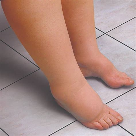 lymphedema   treatments  lymphedema tactile medical