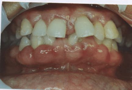 Isolated autosomal dominant hereditary gingival fibromatosis. | Download Scientific Diagram