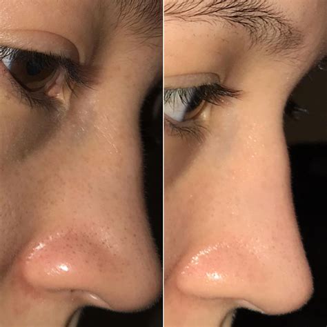 Unbelievable Blackhead Removal 2024: See The Results For Yourself! Image 4