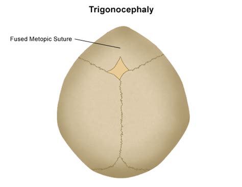 Trigonocephaly | Stanford Health Care