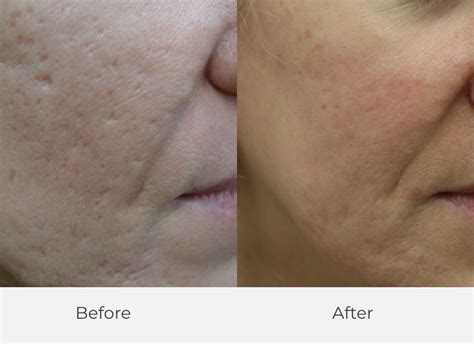 Best Basal Cell Carcinoma Treatment in Australia 2025