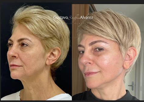 Face Lift Antes E Depois - Antes e depois de Lifting Facial