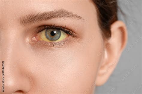 Yellow Eyes Hepatitis