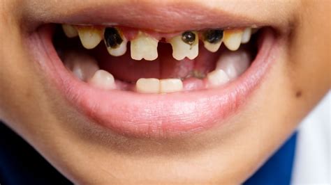 Dente De Criança Sujo - Criança com dente podre: por que, riscos e o que fazer