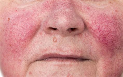 rosacea treatment hunter coast dermatology laser newcastle
