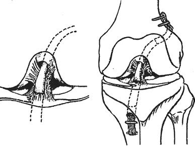 remnant preserving single bundle procedure reported  adachi