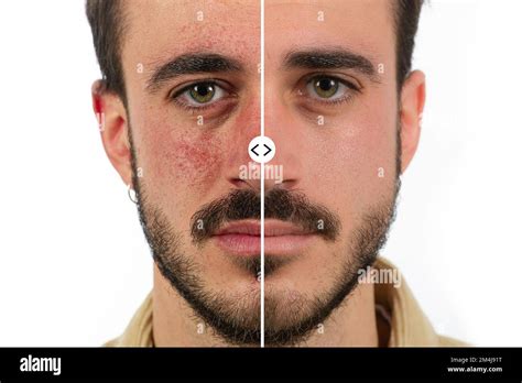 Caucasian male face with red skin rosacea before and after couperose ...