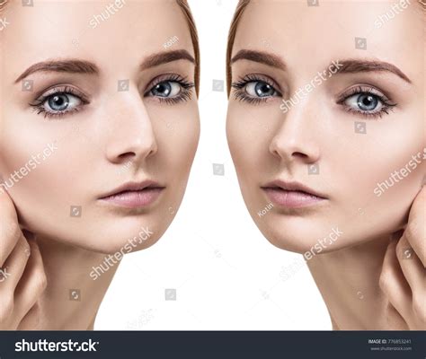 Female Nose Before After Cosmetic Surgery Stock Photo 776853241 ...