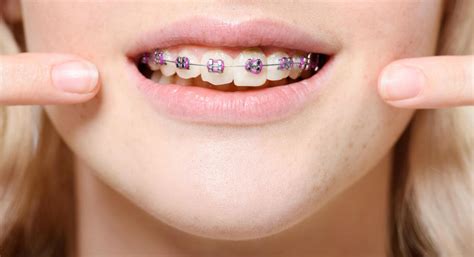 prettiest braces colors