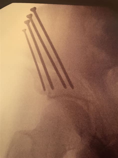 PAO surgery (so wont need hip replacement in 20 years) : r/medizzy