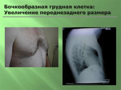 Эмфизема легких - презентация онлайн