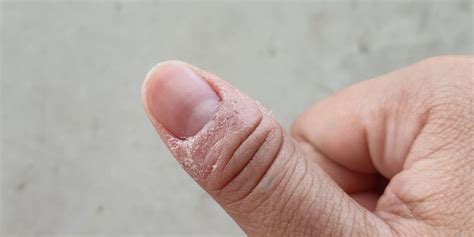 paronychia meaning symptoms  treatment