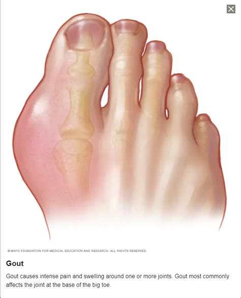 gout colab health