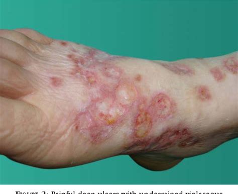 Figure 1 from Synchronous pyoderma gangrenosum and inflammatory bowel ...