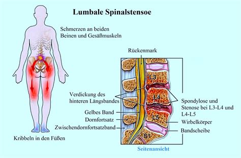 Spondylarthrose, Spondylose, Bandscheibenprotusion, Spinalkanalstenose