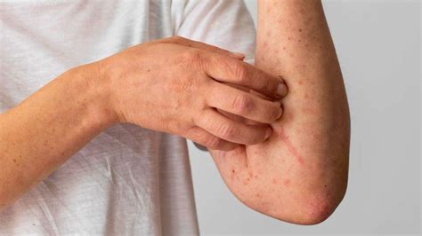 Coceira Após O Banho - Por que algumas pessoas ficam com coceira após exercício ou banho quente?