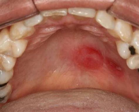 Sifilis Na Lingua Como Tratar - Lingua De Sifilis Primaria Clinical Manifestations Of Syphilis In The