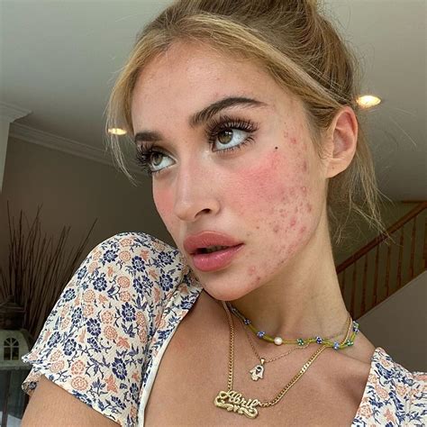 pin  uliana  bystroe soxranenie girl  acne clear skin skin