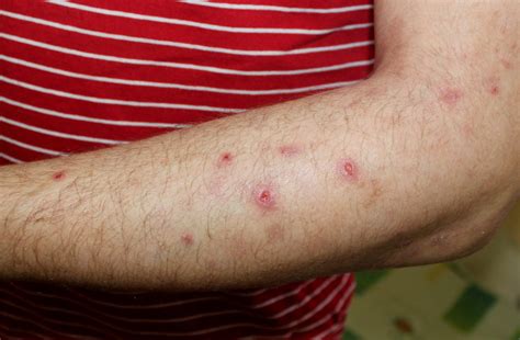 New Drugs: Dupilumab for Prurigo Nodularis - The Dermatology Digest