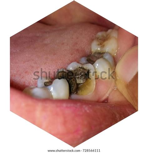 broken molar stock photo  shutterstock