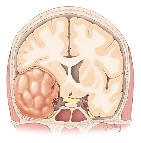 General Information for Meningiomas | Patient Resource Center | The