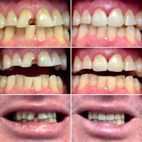 Friday afternoon front teeth fix | Dr. Gentry