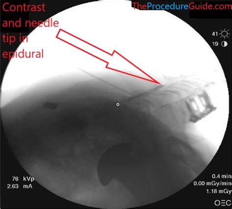 Nexplanon (etonogestrel) Implant/Insertion - Technique and Overview ...