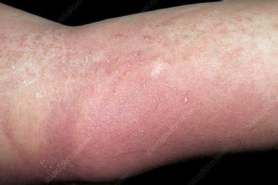 Allergic Reaction Rash On Body