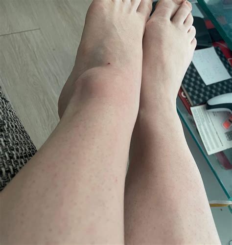 Geschwollene Füße, schmerzende ferse?