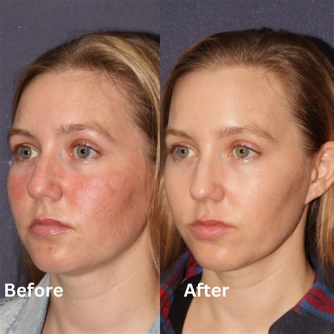 IPL Therapy - Visage TJ