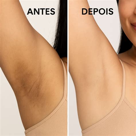 Clareamento Virilha E Axila