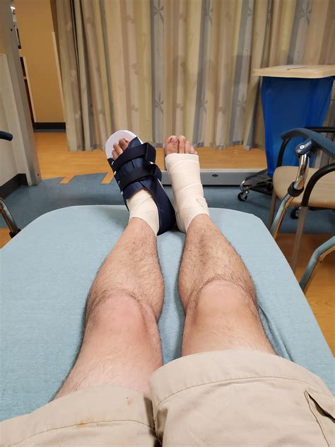 Ran over by a Ram 2500. Fractured left foot. One of many broken bones