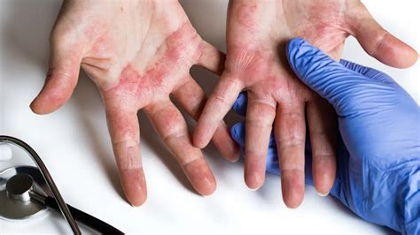 Alergia A Detergente Nas Mãos - Tipos de alergia nas mãos: Causas, sintomas e tratamentos - Notícias em ...