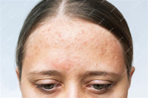 premium photo close   red allergic rash   forehead cropped