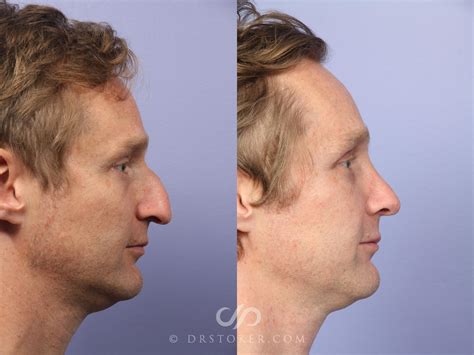 Embracing Change: Plastic Surgery for Men – Dr. David Stoker