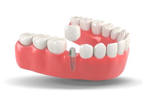 Dental Implants | Charlotte, NC | Charlotte Dental Arts