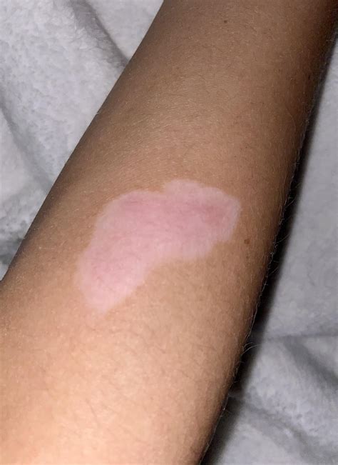 [Misc] Any tips to make my burn scar smaller? : r/SkincareAddiction