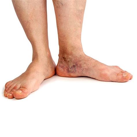 Patients with severe venous disease may have signs such as venous ...